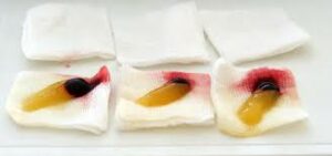 PRF choukroun greffes osseuses