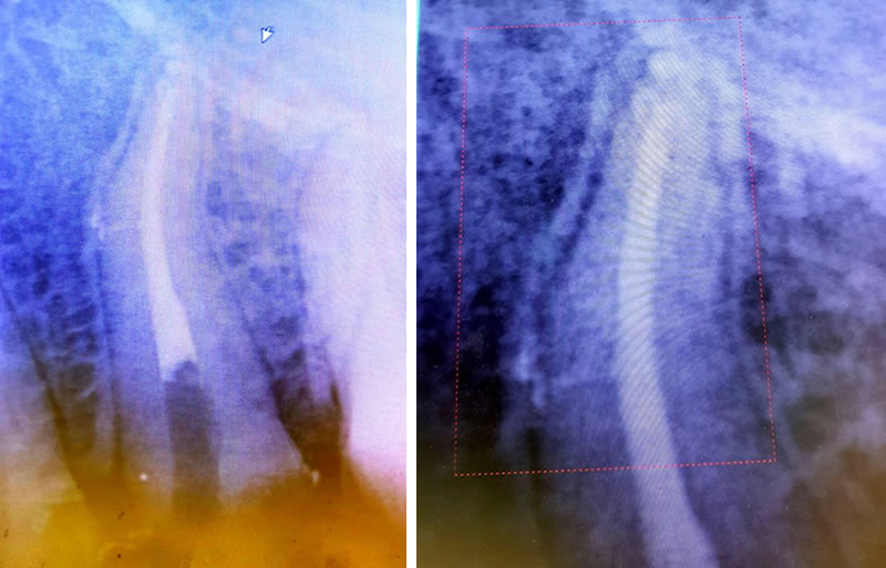 Obturation of the lateral accessory canal in the middle of the root. Lateral condensation technique with hot gutta percha.