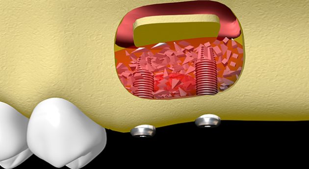 dent manquante: la solution d'un implant dentaire greffes osseuses