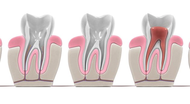 endodontie dévitalisation des dents