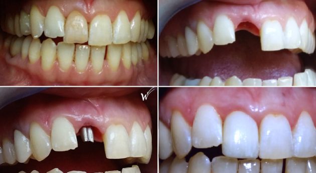 Remplacement d'une dent du sourire comme un incisive centrale par un implant dentaire et une couronne cosmétique