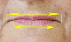 Rétrécissement apparent des lèvres : Les vraies commissures anatomiques des lèvres ne coïncident plus avec les commissures visibles des lèvres qui semblent se déplacer vers le milieu de la bouche. La bouche et les lèvres donnent l’impression d’être rétrécies.