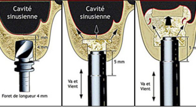 sinus lift summers greffes osseuses implant dentaire